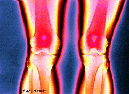 Knees XRay