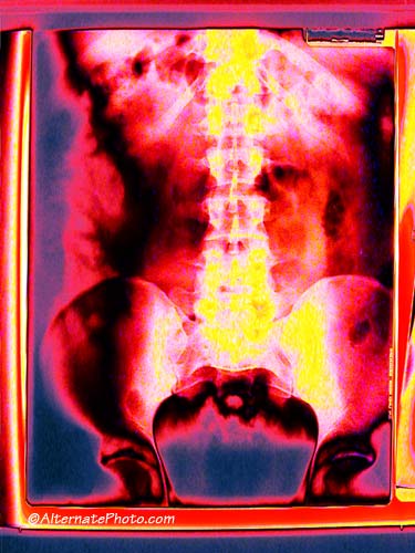 Spine XRay