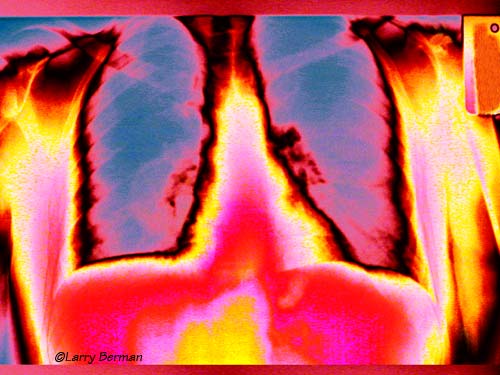 Chest XRay