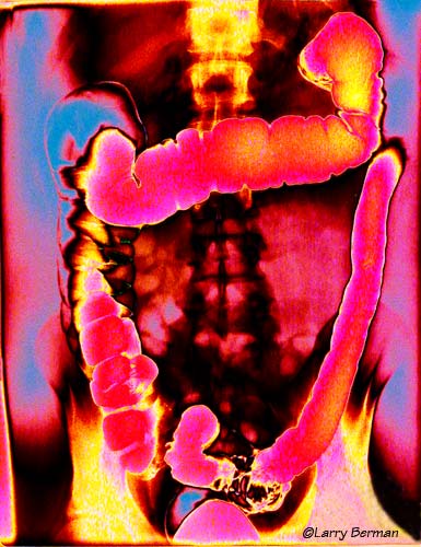 Colon XRay