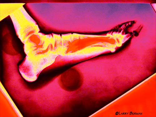 Foot XRay