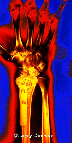 XRay of wrist with a metal plate